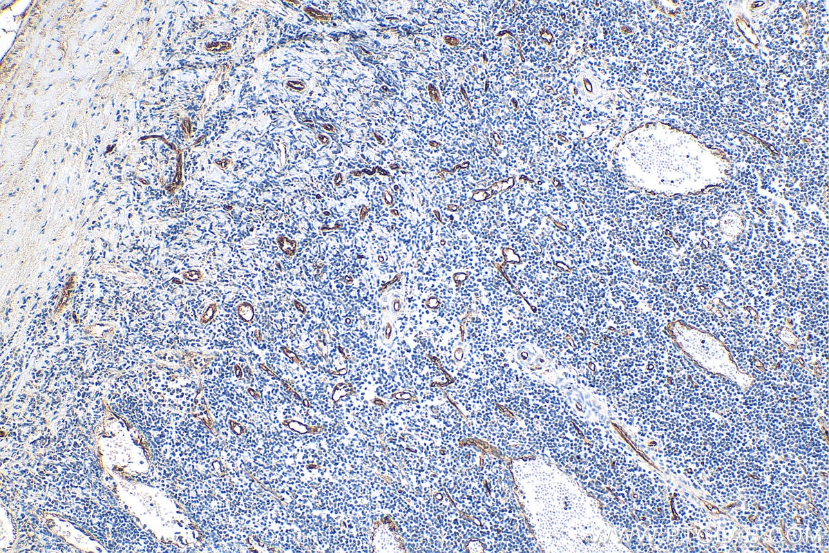 Immunohistochemistry (IHC) staining of human tonsillitis tissue using CD34 Polyclonal antibody (14486-1-AP)