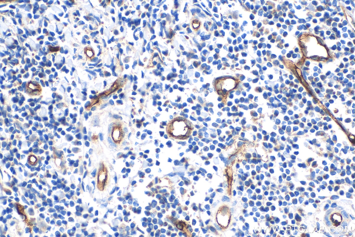 Immunohistochemistry (IHC) staining of human tonsillitis tissue using CD34 Polyclonal antibody (14486-1-AP)