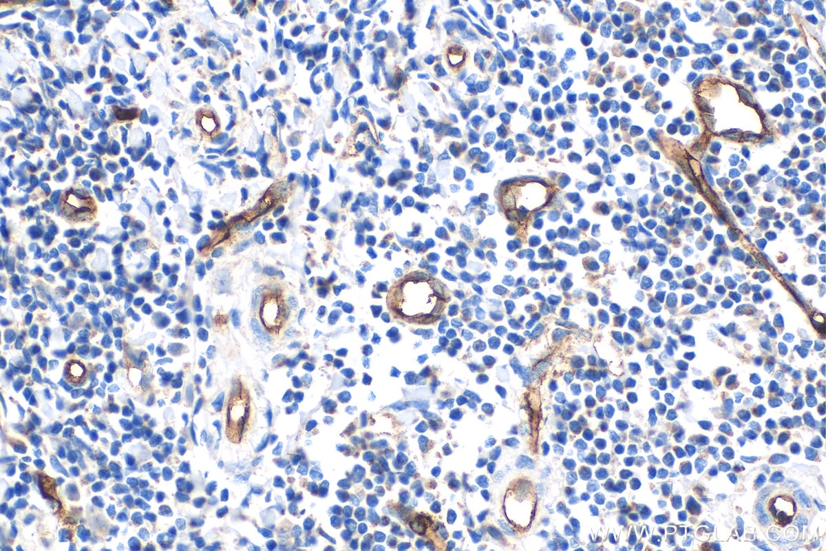 IHC staining of human tonsillitis using 14486-1-AP