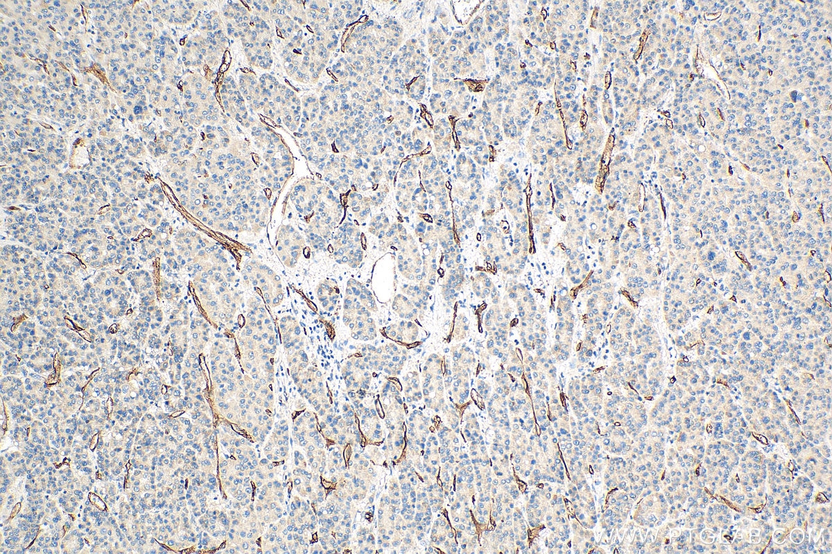 Immunohistochemistry (IHC) staining of human liver cancer tissue using CD34 Polyclonal antibody (14486-1-AP)