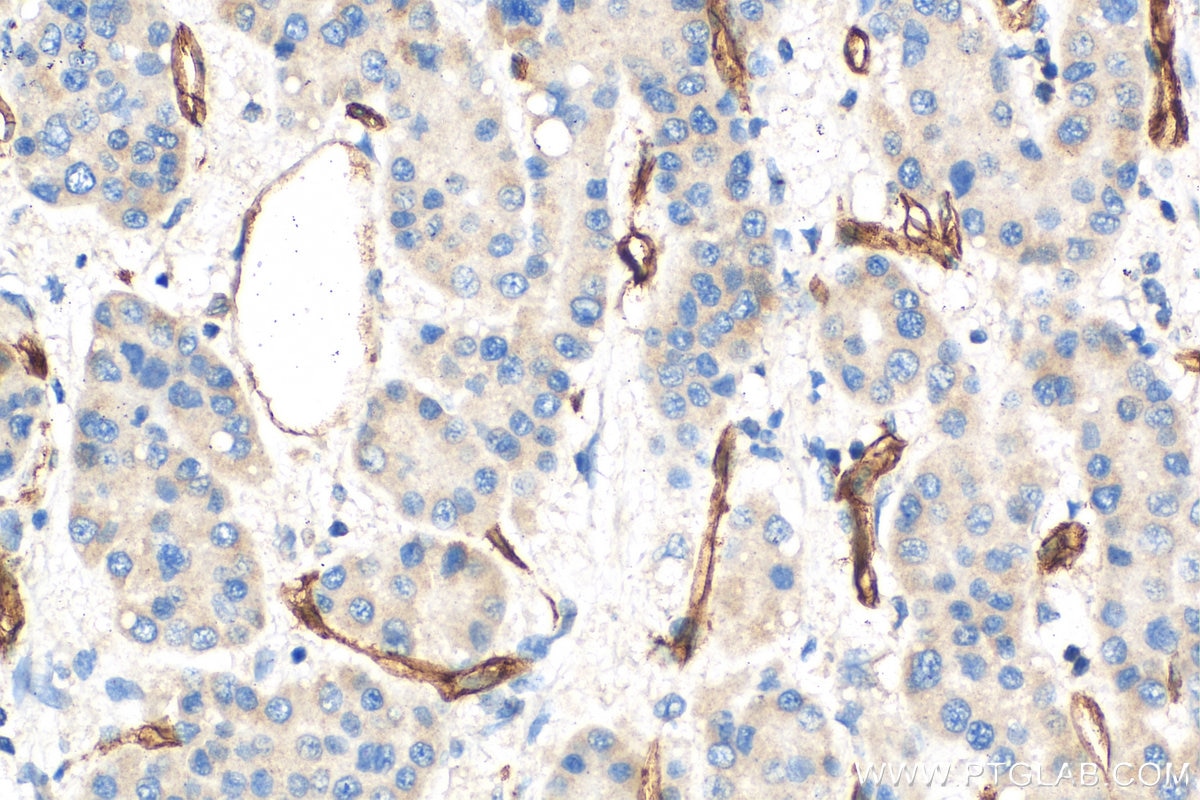 Immunohistochemistry (IHC) staining of human liver cancer tissue using CD34 Polyclonal antibody (14486-1-AP)