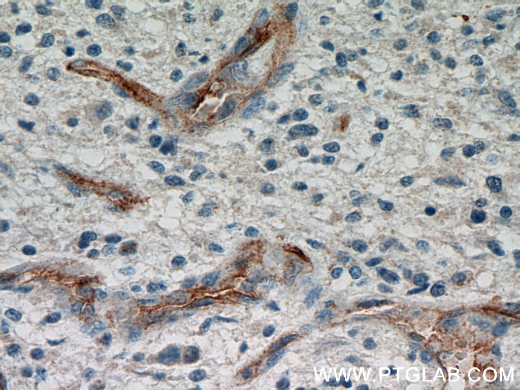 Immunohistochemistry (IHC) staining of human gliomas tissue using CD34 Polyclonal antibody (14486-1-AP)