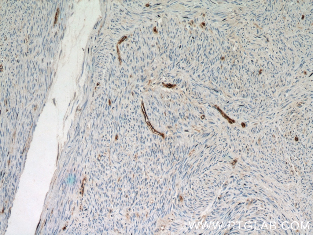 Immunohistochemistry (IHC) staining of human hysteromyoma tissue using CD34 Polyclonal antibody (14486-1-AP)