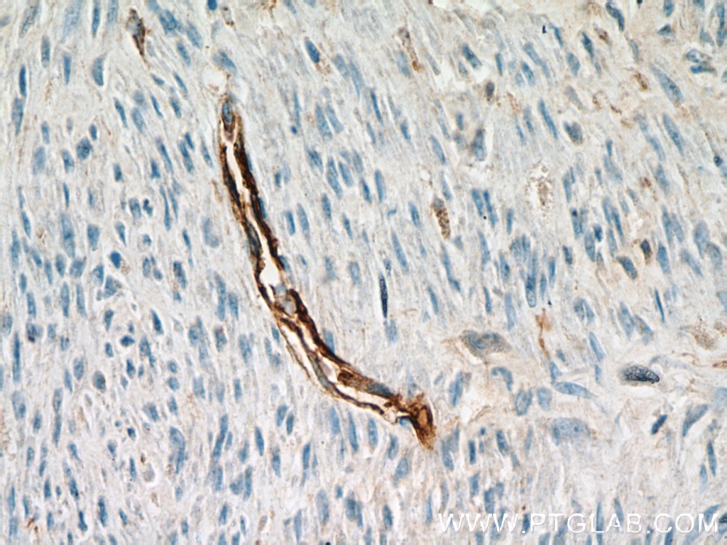 Immunohistochemistry (IHC) staining of human hysteromyoma tissue using CD34 Polyclonal antibody (14486-1-AP)