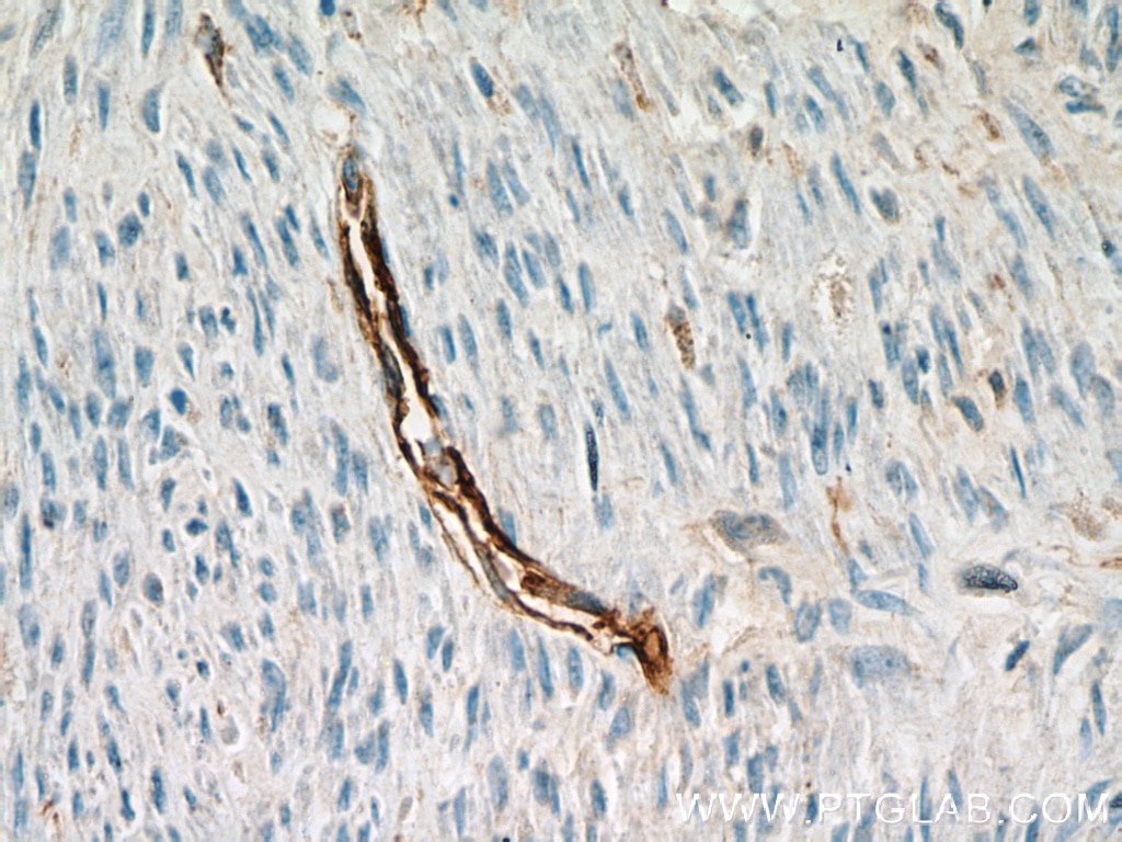 IHC staining of human hysteromyoma using 14486-1-AP