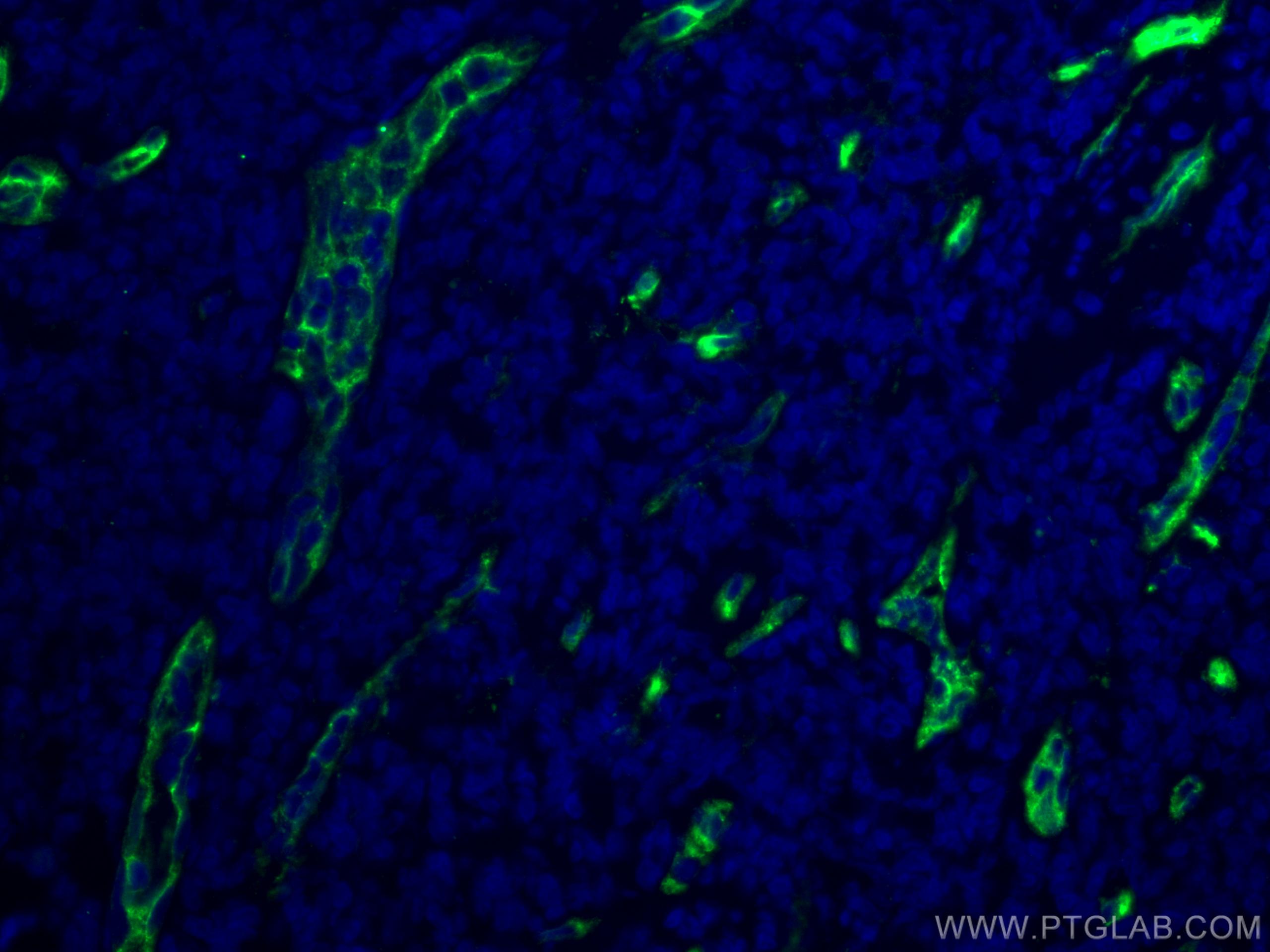 IF Staining of human tonsillitis using 60180-1-Ig