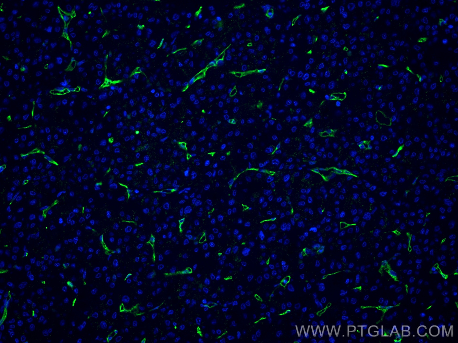 Immunofluorescence (IF) / fluorescent staining of human liver cancer tissue using CD34 Monoclonal antibody (60180-1-Ig)
