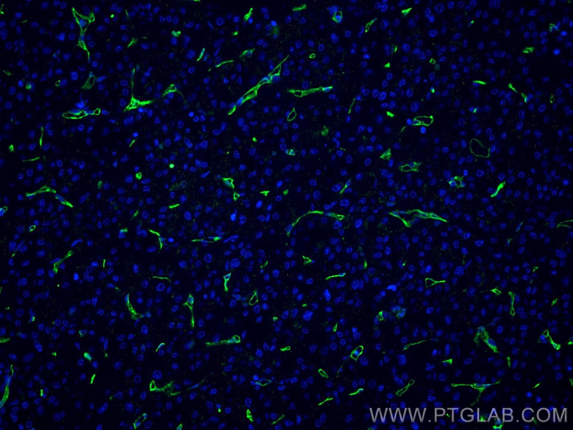 IF Staining of human liver cancer using 60180-1-Ig