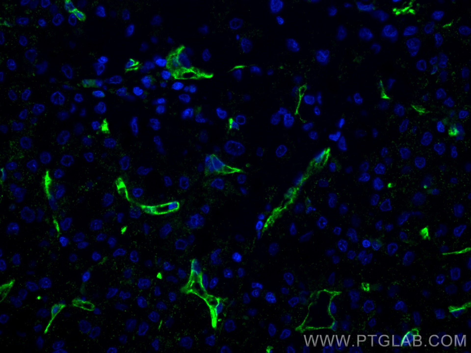 Immunofluorescence (IF) / fluorescent staining of human liver cancer tissue using CD34 Monoclonal antibody (60180-1-Ig)