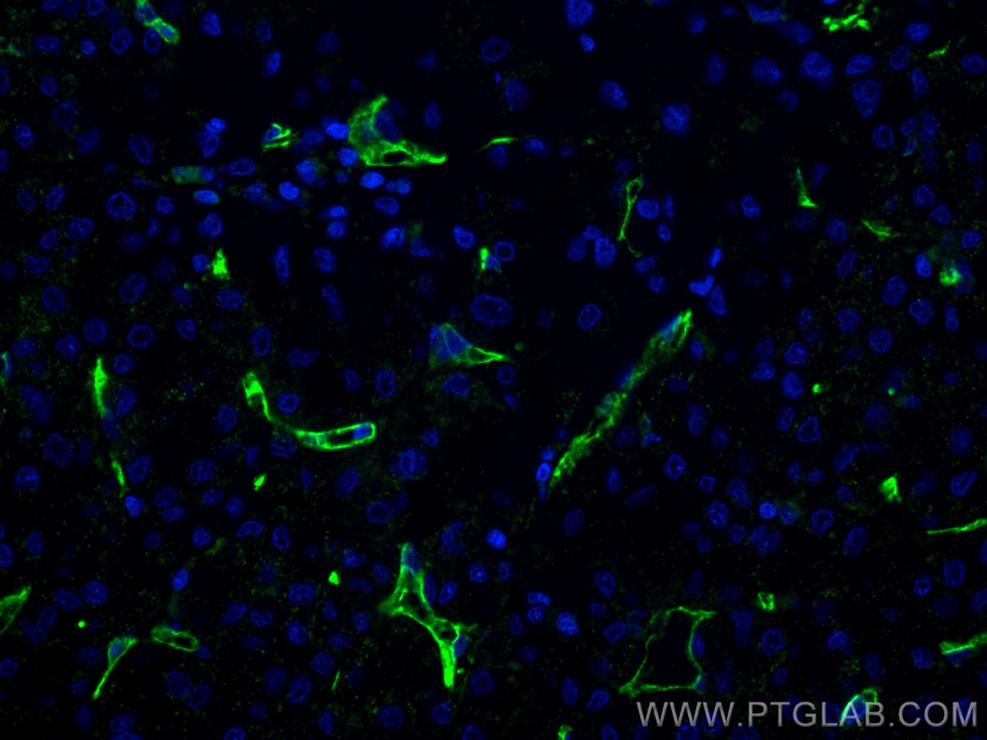 Immunofluorescence (IF) / fluorescent staining of human liver cancer tissue using CD34 Monoclonal antibody (60180-1-Ig)