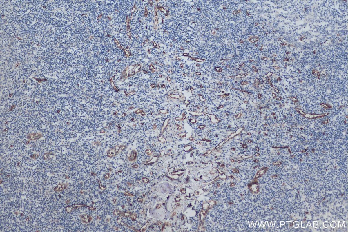 IHC staining of human tonsillitis using 60180-1-Ig