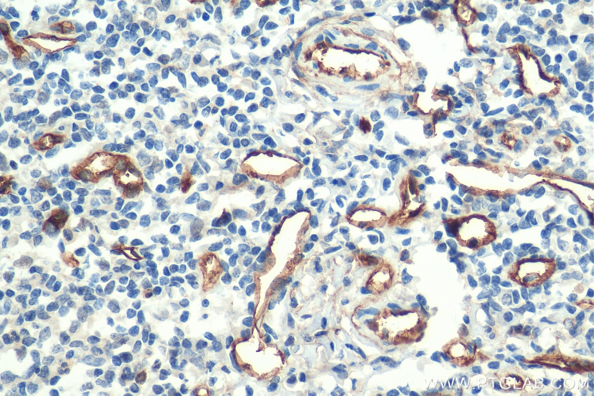 Immunohistochemistry (IHC) staining of human tonsillitis tissue using CD34 Monoclonal antibody (60180-1-Ig)