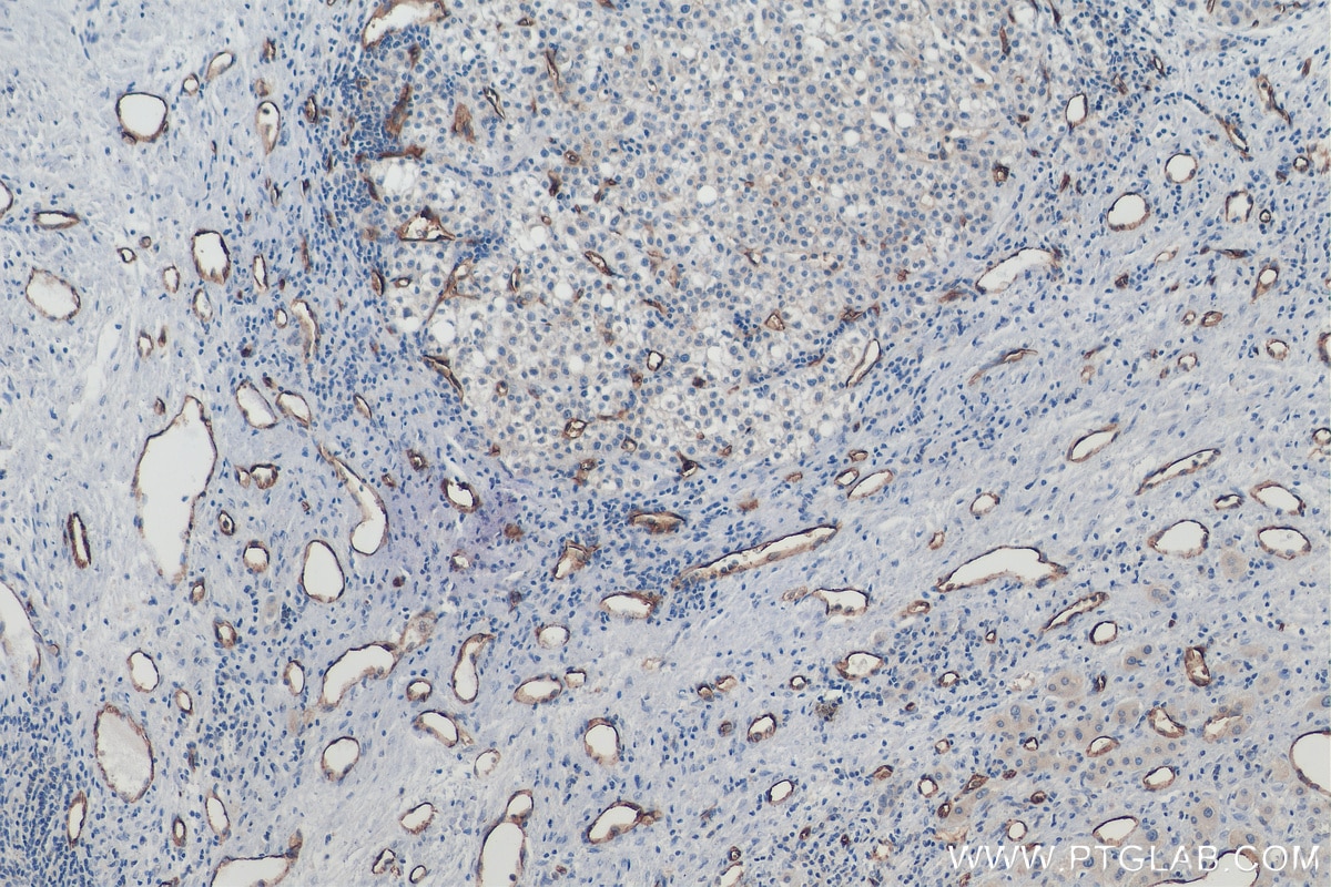 Immunohistochemistry (IHC) staining of human liver cancer tissue using CD34 Monoclonal antibody (60180-1-Ig)