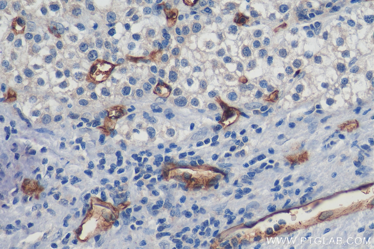 Immunohistochemistry (IHC) staining of human liver cancer tissue using CD34 Monoclonal antibody (60180-1-Ig)