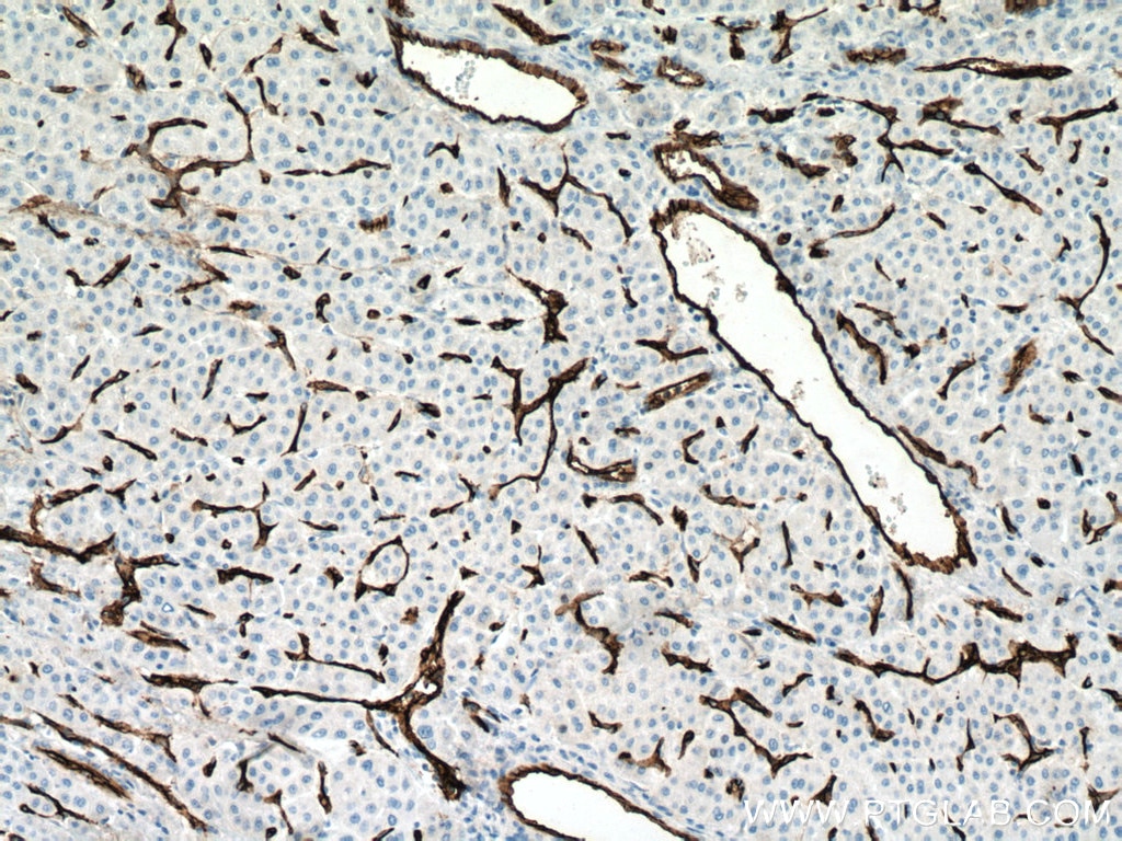 Immunohistochemistry (IHC) staining of human liver cancer tissue using CD34 Monoclonal antibody (60180-2-Ig)