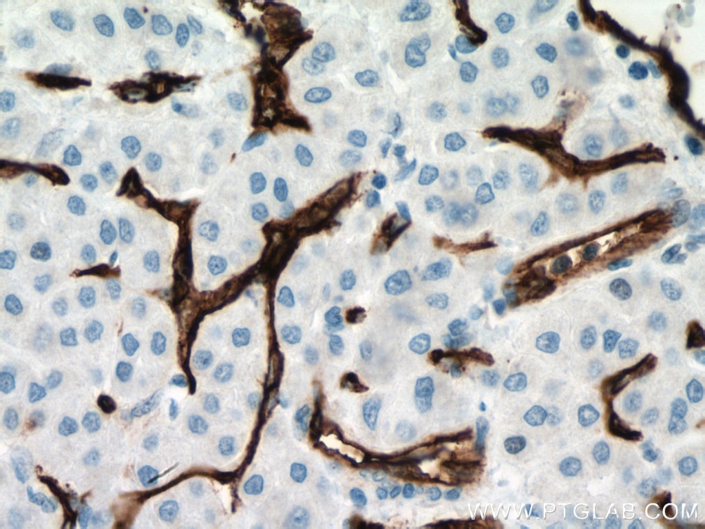 Immunohistochemistry (IHC) staining of human liver cancer tissue using CD34 Monoclonal antibody (60180-2-Ig)