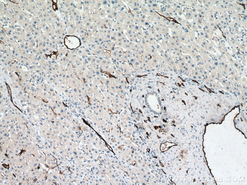 Immunohistochemistry (IHC) staining of human liver cancer tissue using CD34 Monoclonal antibody (60180-2-Ig)