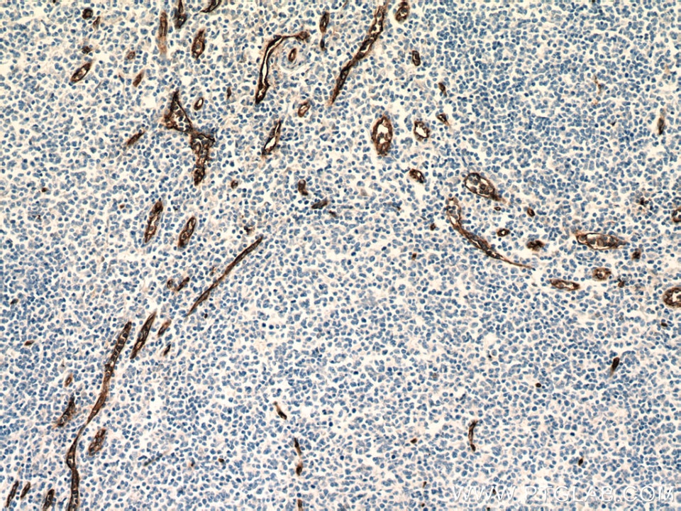 Immunohistochemistry (IHC) staining of human tonsillitis tissue using CD34 Monoclonal antibody (60180-2-Ig)