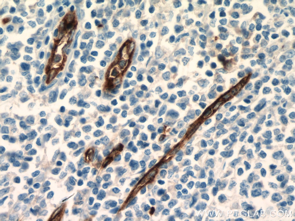 Immunohistochemistry (IHC) staining of human tonsillitis tissue using CD34 Monoclonal antibody (60180-2-Ig)