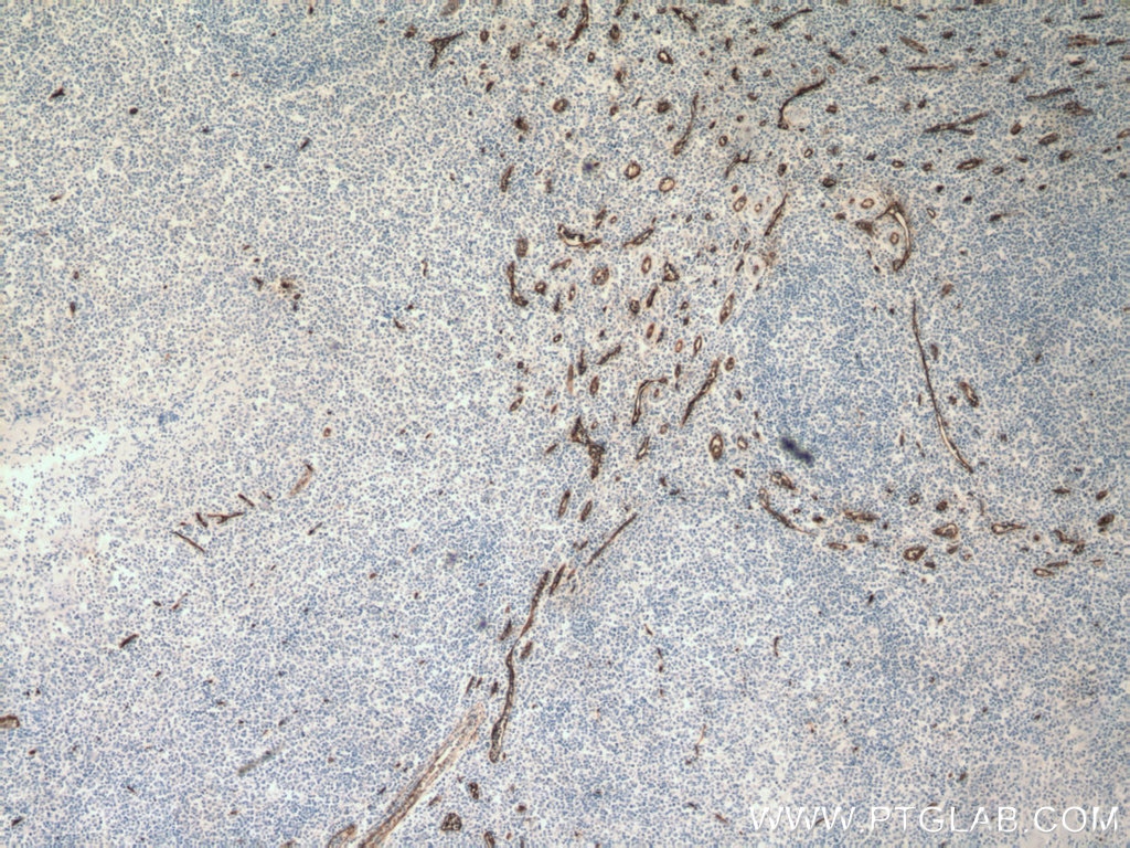 Immunohistochemistry (IHC) staining of human tonsillitis tissue using CD34 Monoclonal antibody (60180-2-Ig)