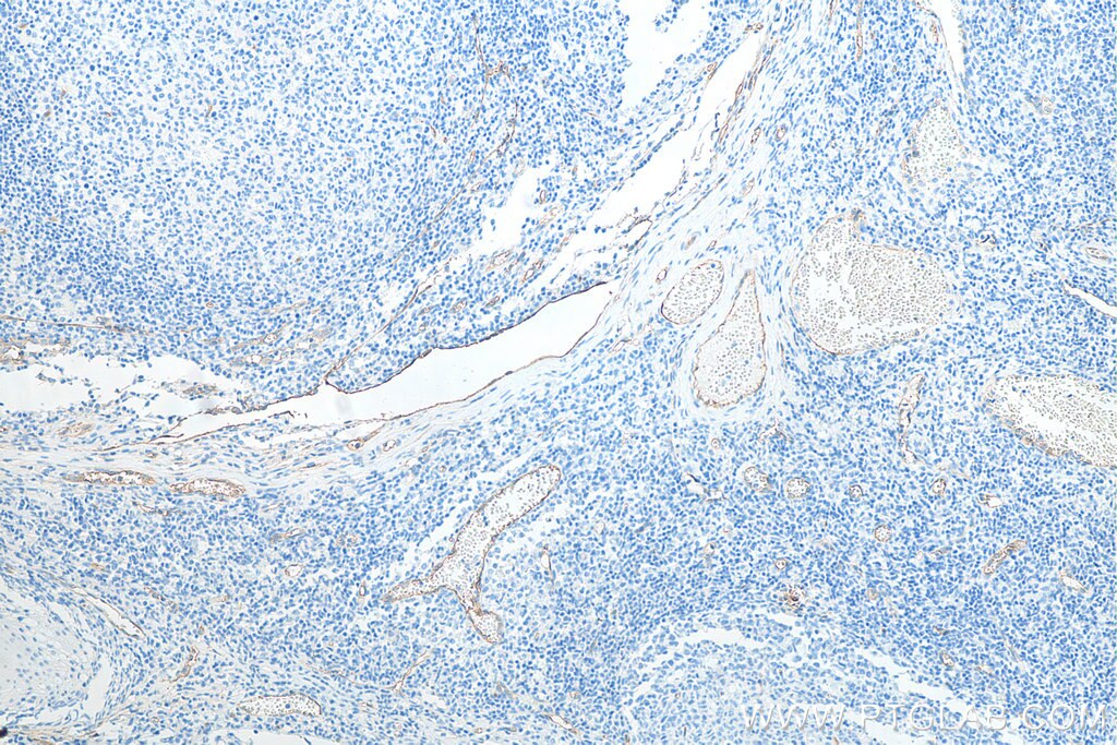 Immunohistochemistry (IHC) staining of human tonsillitis tissue using CD34 Monoclonal antibody (60180-2-Ig)