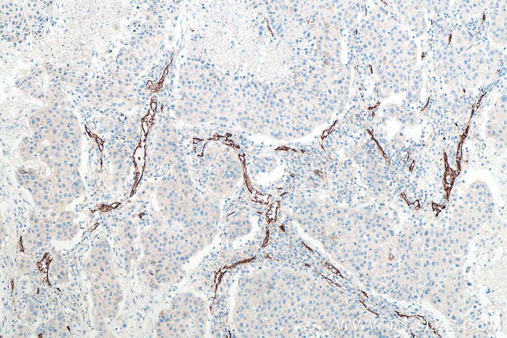 Immunohistochemistry (IHC) staining of human breast cancer tissue using CD34 Monoclonal antibody (60180-2-Ig)