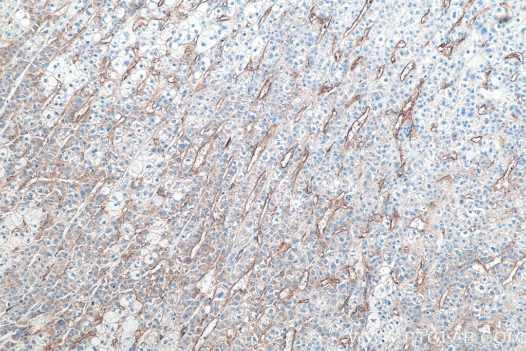Immunohistochemistry (IHC) staining of human liver cancer tissue using CD34 Monoclonal antibody (60180-2-Ig)