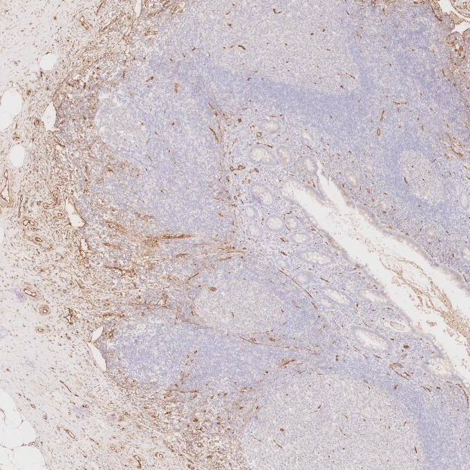 Immunohistochemistry (IHC) staining of human appendicitis tissue using CD34 Monoclonal antibody (60180-2-Ig)