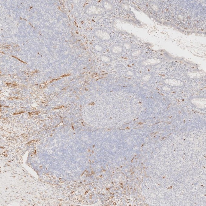 Immunohistochemistry (IHC) staining of human appendicitis tissue using CD34 Monoclonal antibody (60180-2-Ig)