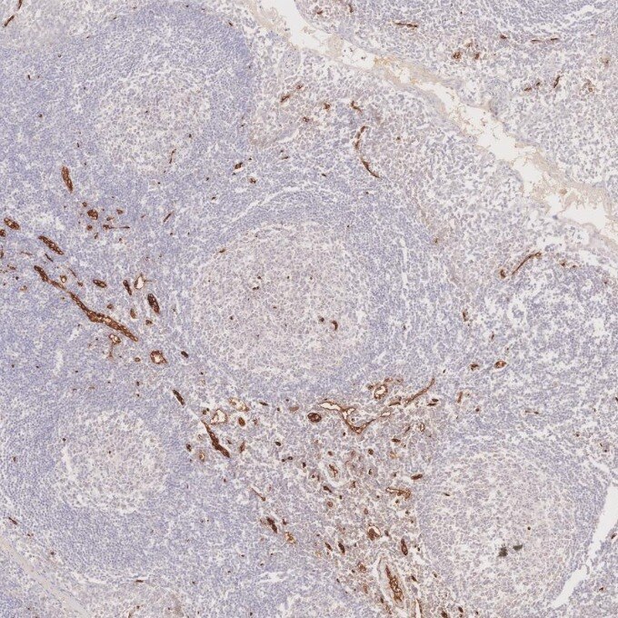 Immunohistochemistry (IHC) staining of human tonsillitis tissue using CD34 Monoclonal antibody (60180-2-Ig)