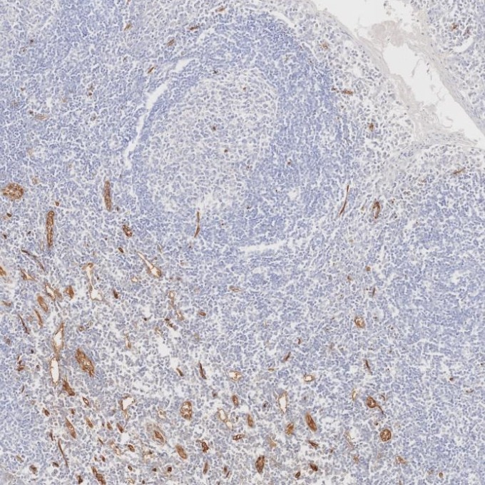 Immunohistochemistry (IHC) staining of human tonsillitis tissue using CD34 Monoclonal antibody (60180-2-Ig)