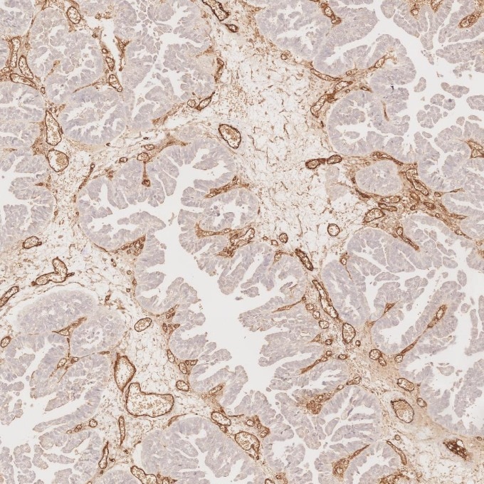 Immunohistochemistry (IHC) staining of human ovary cancer tissue using CD34 Monoclonal antibody (60180-2-Ig)