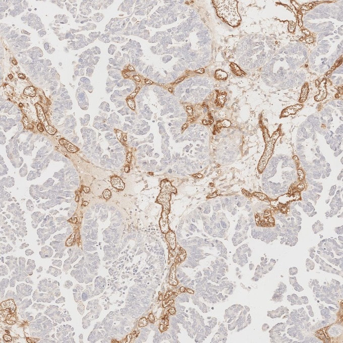 Immunohistochemistry (IHC) staining of human ovary cancer tissue using CD34 Monoclonal antibody (60180-2-Ig)
