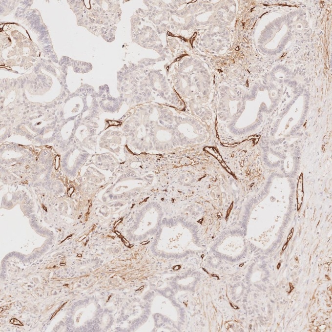Immunohistochemistry (IHC) staining of human pancreas cancer tissue using CD34 Monoclonal antibody (60180-2-Ig)