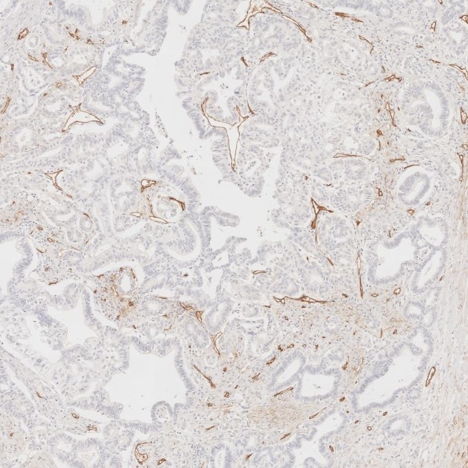 Immunohistochemistry (IHC) staining of human pancreas cancer tissue using CD34 Monoclonal antibody (60180-2-Ig)