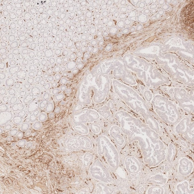 Immunohistochemistry (IHC) staining of human colorectal cancer tissue using CD34 Monoclonal antibody (60180-2-Ig)