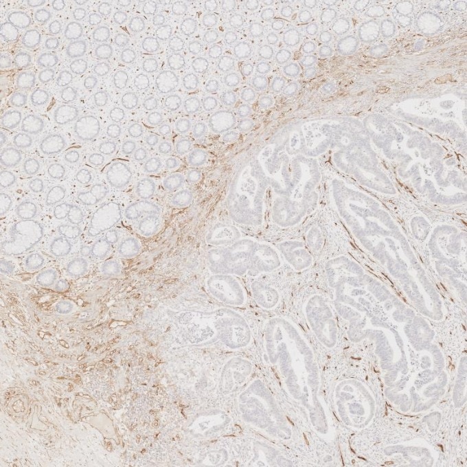 Immunohistochemistry (IHC) staining of human colorectal cancer tissue using CD34 Monoclonal antibody (60180-2-Ig)
