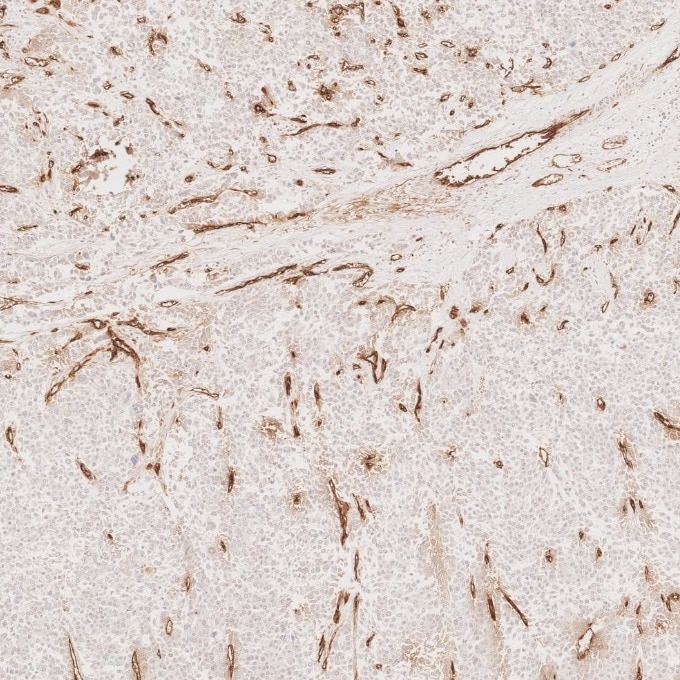 Immunohistochemistry (IHC) staining of human liver cancer tissue using CD34 Monoclonal antibody (60180-2-Ig)