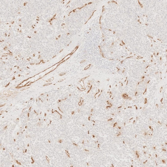 Immunohistochemistry (IHC) staining of human liver cancer tissue using CD34 Monoclonal antibody (60180-2-Ig)
