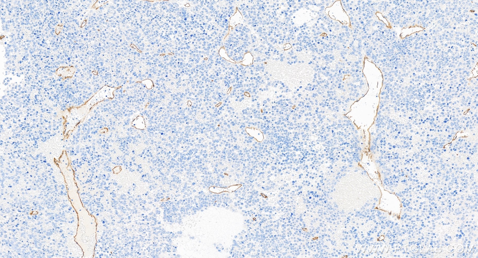 Immunohistochemistry (IHC) staining of human liver cancer tissue using CD34 Recombinant antibody (84242-5-RR)