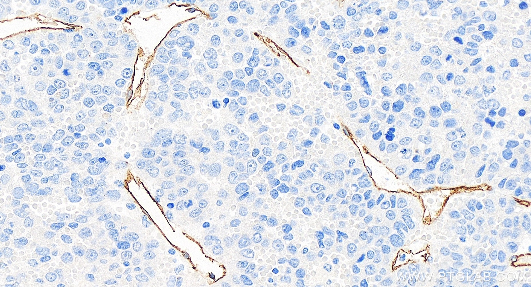 Immunohistochemistry (IHC) staining of human liver cancer tissue using CD34 Recombinant antibody (84242-5-RR)