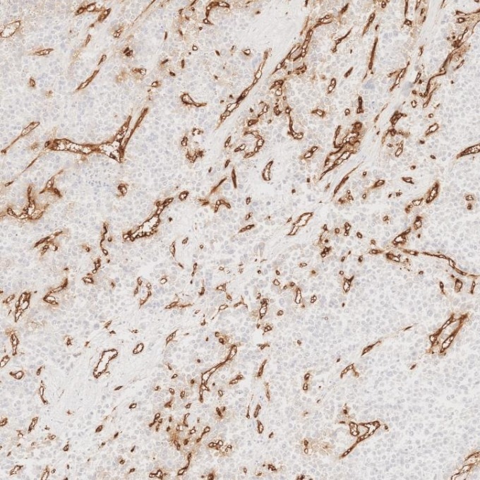 Immunohistochemistry (IHC) staining of human liver cancer tissue using CD34 Recombinant monoclonal antibody (84242-5-RR)