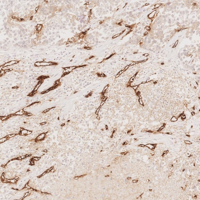 Immunohistochemistry (IHC) staining of human liver cancer tissue using CD34 Recombinant monoclonal antibody (84242-5-RR)