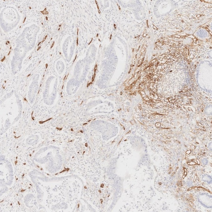 Immunohistochemistry (IHC) staining of human colorectal cancer tissue using CD34 Recombinant monoclonal antibody (84242-5-RR)
