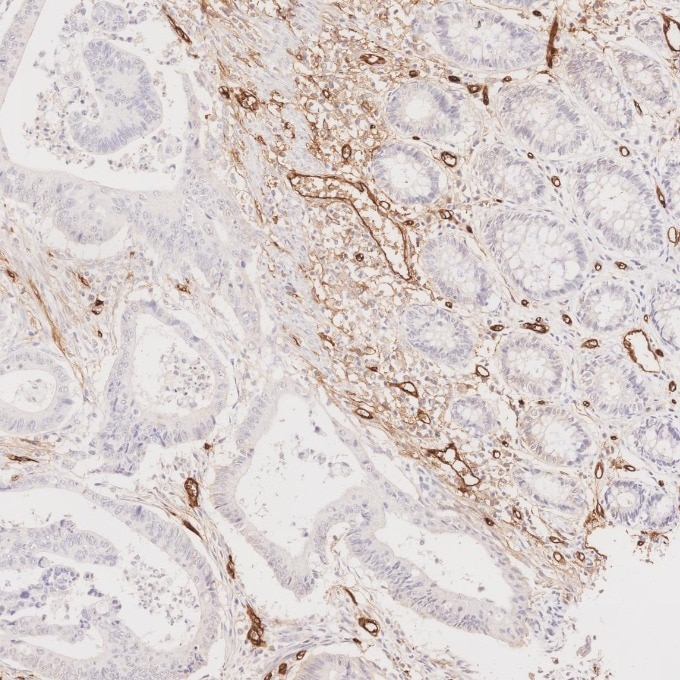Immunohistochemistry (IHC) staining of human colorectal cancer tissue using CD34 Recombinant monoclonal antibody (84242-5-RR)