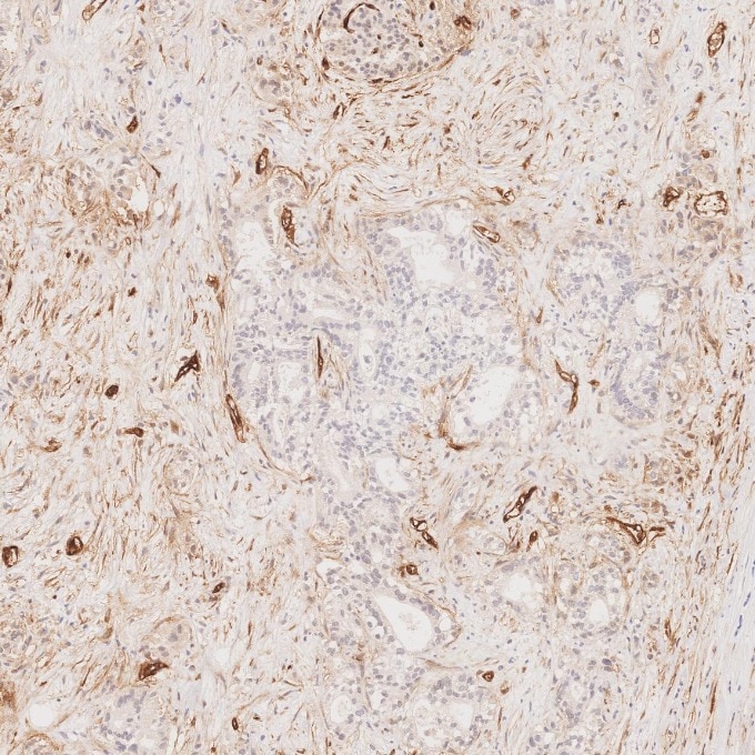 Immunohistochemistry (IHC) staining of human pancreas cancer tissue using CD34 Recombinant monoclonal antibody (84242-5-RR)