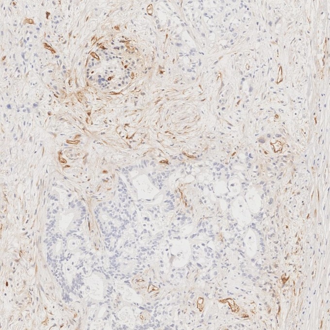 Immunohistochemistry (IHC) staining of human pancreas cancer tissue using CD34 Recombinant monoclonal antibody (84242-5-RR)