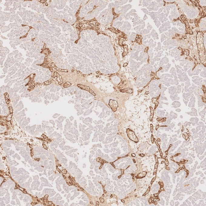 Immunohistochemistry (IHC) staining of human ovary cancer tissue using CD34 Recombinant monoclonal antibody (84242-5-RR)