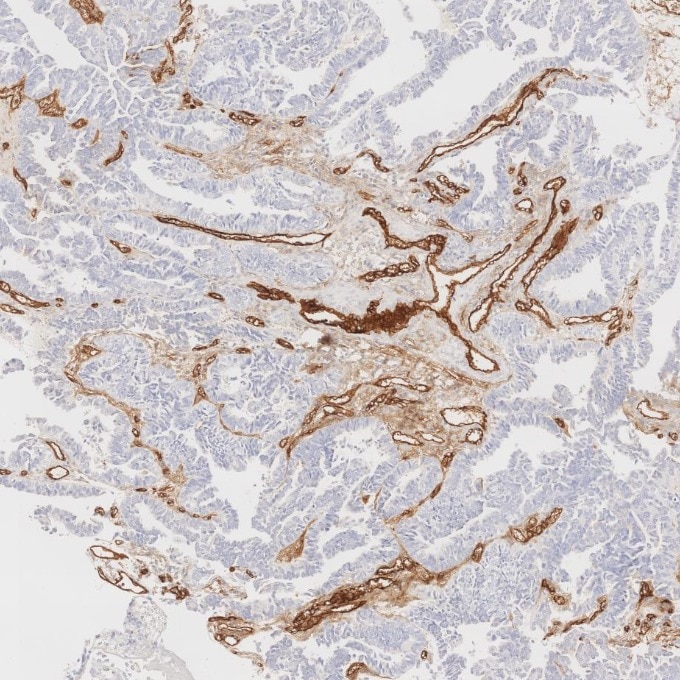Immunohistochemistry (IHC) staining of human ovary cancer tissue using CD34 Recombinant monoclonal antibody (84242-5-RR)