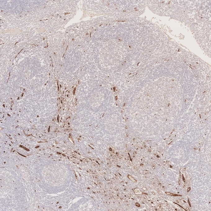 Immunohistochemistry (IHC) staining of human tonsillitis tissue using CD34 Recombinant monoclonal antibody (84242-5-RR)